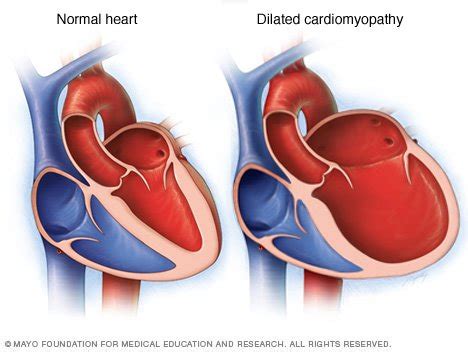 left ventricular dilation